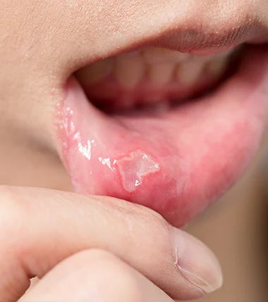 Mouth ulcers